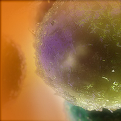 Gastric adenocarcinoma with high‑level microsatellite instability: A case report