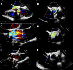 BASILICA Procedure Prior to Valve-in-Valve TAVR in a Supra-Annular TAV Prosthesis
