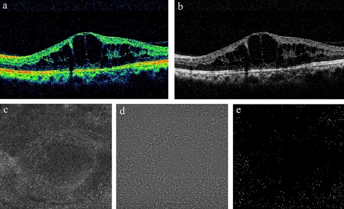 Elevated number and density of macrophage-like cell as a novel inflammation biomarker in diabetic macular edema - Scientific Reports