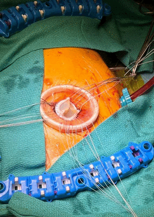Consensus statement on aortic valve replacement via an anterior right minithoracotomy in the UK healthcare setting