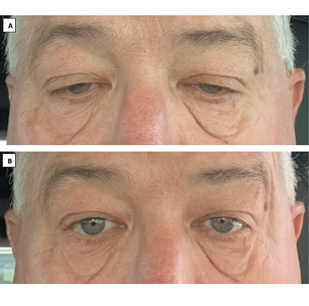Oxymetazoline Hydrochloride Eye-Drops as Treatment for Myasthenia Gravis-Related Ptosis: A Description of Two Cases