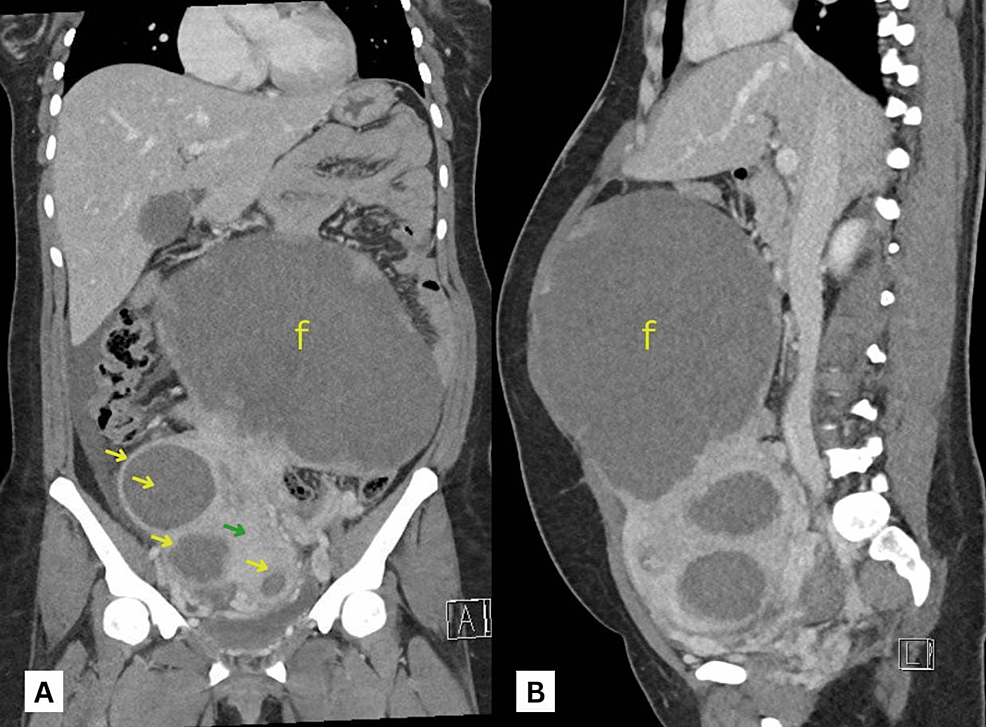 Small Bowel Obstruction as a Complication of Uterine Fibroids: A Case Report