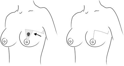 Dermoglandular advancement-rotation flap for conservative treatment of breast cancer - description of technique, objective and subjective assessments