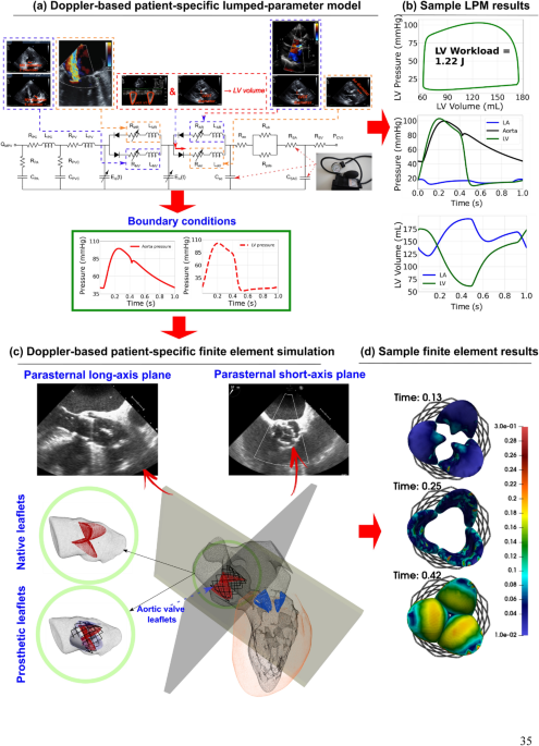 A Doppler-exclusive non-invasive computational diagnostic framework for personalized transcatheter aortic valve replacement - Scientific Reports