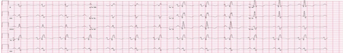 An interesting case of pulmonary hypertension in nephrotic syndrome due to amphetamine use for attention-deficit hyperactivity disorder