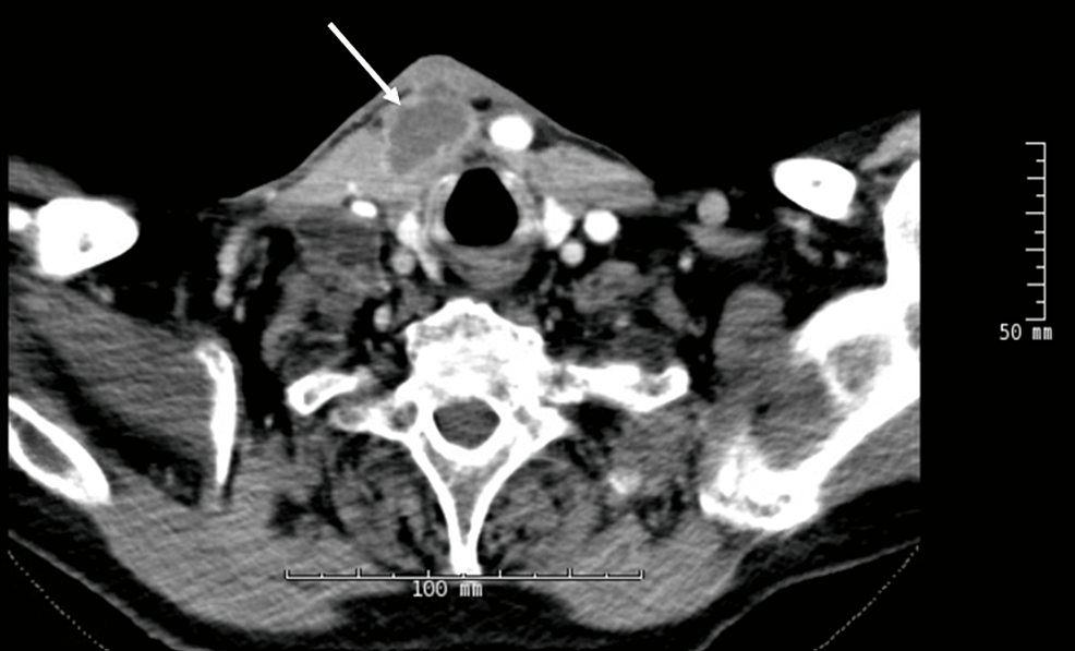 Immune Reconstitution Inflammatory Syndrome Reaction in Patient on Long-Term Prednisone