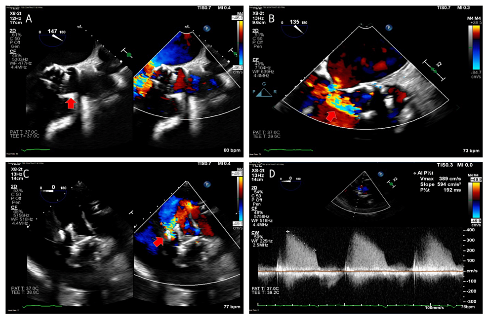 Surgical Aortic Valve Replacement to Treat Prosthetic Valve Endocarditis After Valve-in-Valve Transcatheter Aortic Valve Replacement