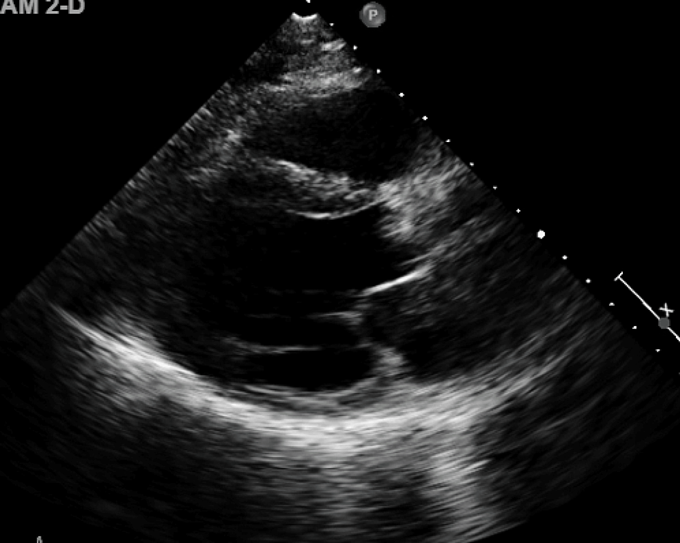 An Unusual Case of Severe Aortic Stenosis and Triple-Vessel Coronary Artery Disease in a Patient Presenting With Intermittent Chest Pain