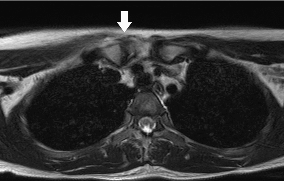 Sternoclavicular Septic Arthritis Due to Invasive Pneumococcal Infection After Type A Influenza Virus Infection