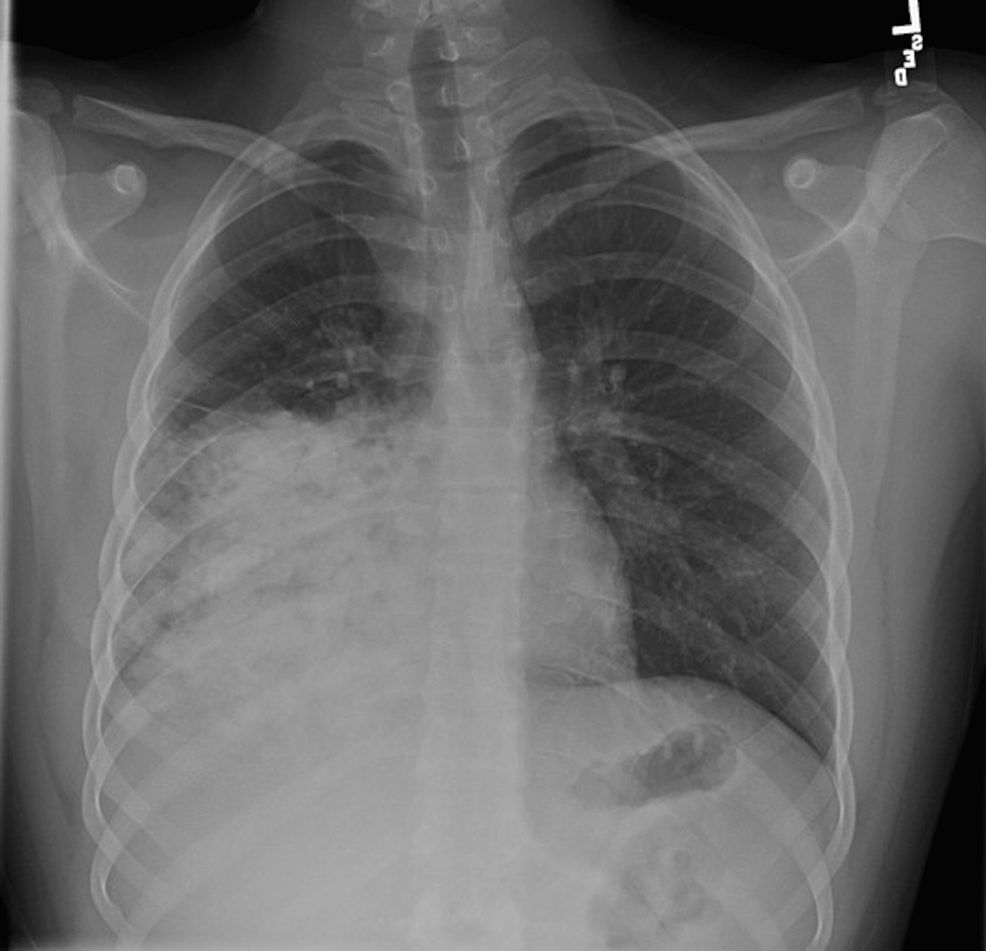 Travel Does More Than Widens One's Horizon: Travel History as Key to Diagnosing Blastomycosis