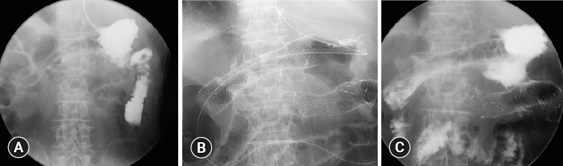 Gastric cancer presenting with ramucirumab-related gastrocolic fistula successfully managed by colonic stenting: a case report