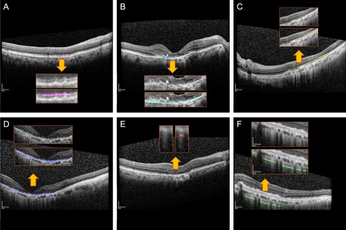 Deep learning to detect macular atrophy in wet age-related macular degeneration using optical coherence tomography - Scientific Reports