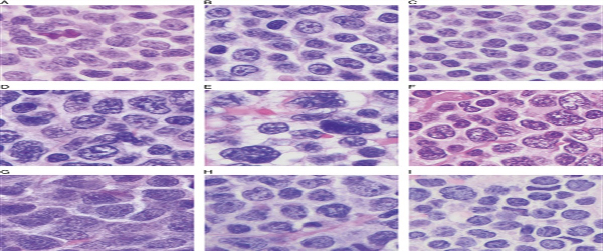 Blastoid and Pleomorphic Mantle Cell Lymphoma Demonstrate... : The American Journal of Surgical Pathology