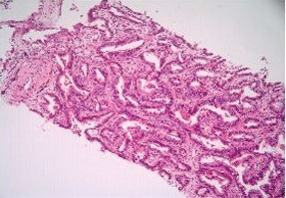 Myasthenia-like paraneoplastic syndrome with multiple... : Medicine