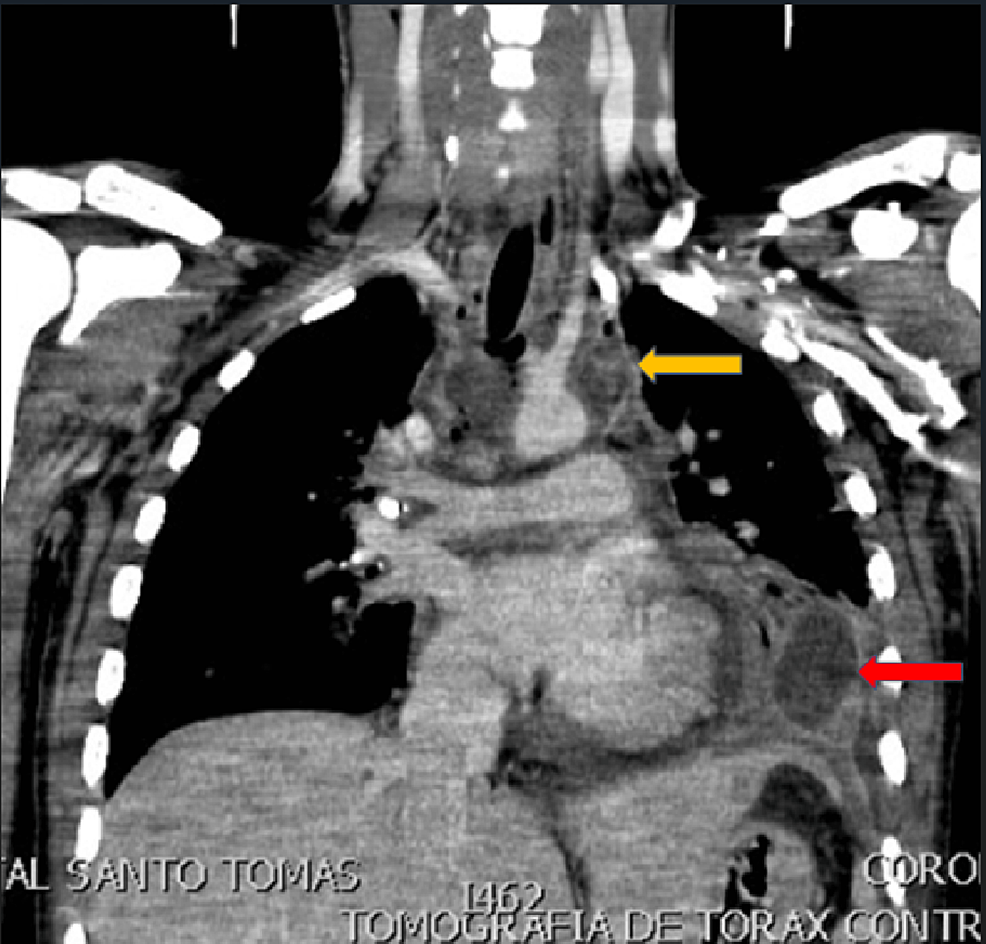 Descending Necrotizing Mediastinitis by Streptococcus anginosus and Prevotella buccae in an Intensive Care Unit Patient: A Case Report