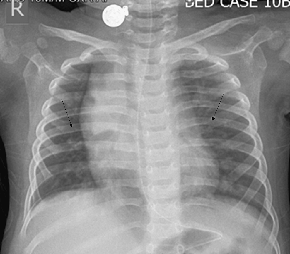 Human Adenovirus Infection Causing Hyperinflammatory Syndrome Mimicking Multisystem Inflammatory Syndrome in Children (MIS-C): A Case Report