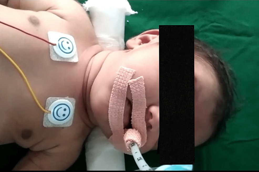 When Breathing Becomes a Challenge: A Case of Congenital Myasthenia Gravis in an Indian Neonate With a DOK-7 Gene Mutation