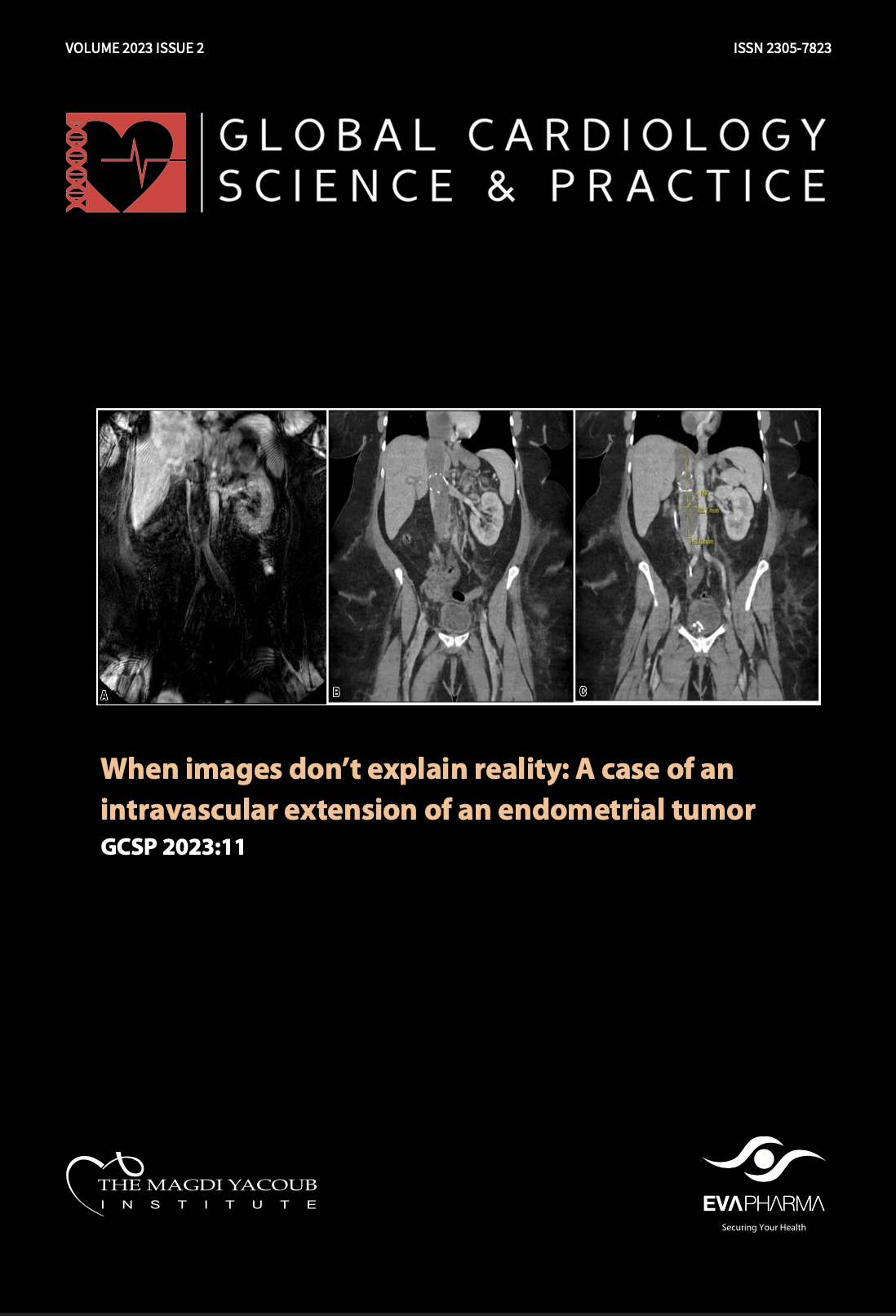 Lessons from a pre-specified meta-analysis of sodium-glucose cotransporter-2 (SGLT2) inhibitors in heart failure: Time for new clinical recommendations