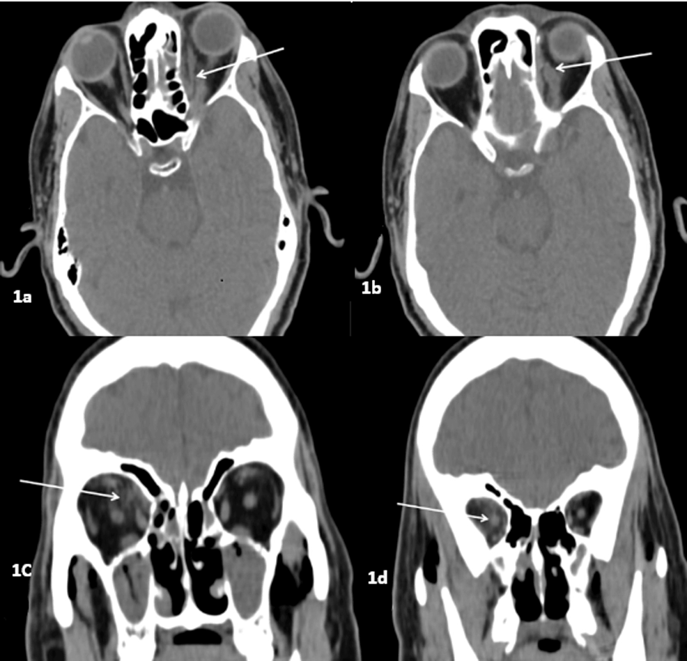 The Radiological Spectrum of Rhino-Oculo-Cerebral Mucormycosis