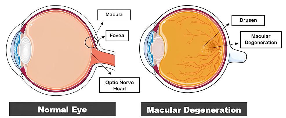 Age-Related Macular Degeneration: An Exponentially Emerging Imminent Threat of Visual Impairment and Irreversible Blindness