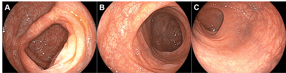 Collagenous Colitis in a Patient With Gastric Cancer Who Underwent Chemotherapy